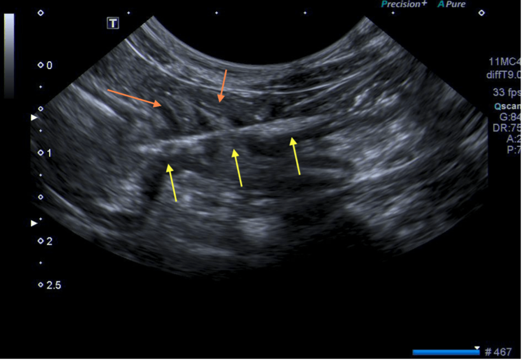 Figure 4: Ecografía abdominal donde se aprecia el plicamiento intestinal y el cuerpo extraño lineal.